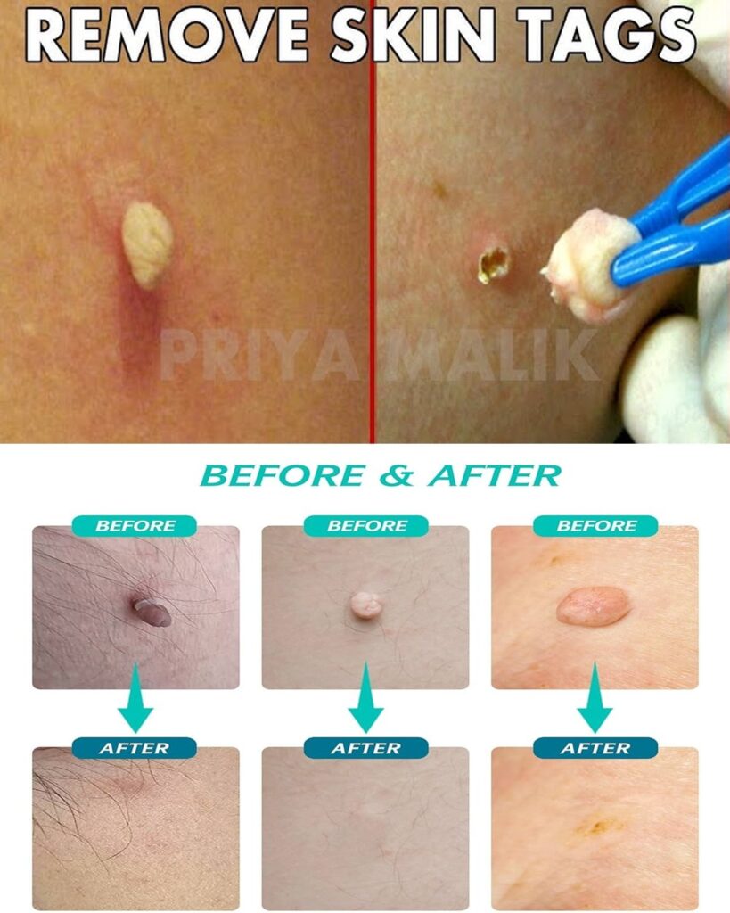 Remove Skin Tags in 3 Days with One Simple Candle!