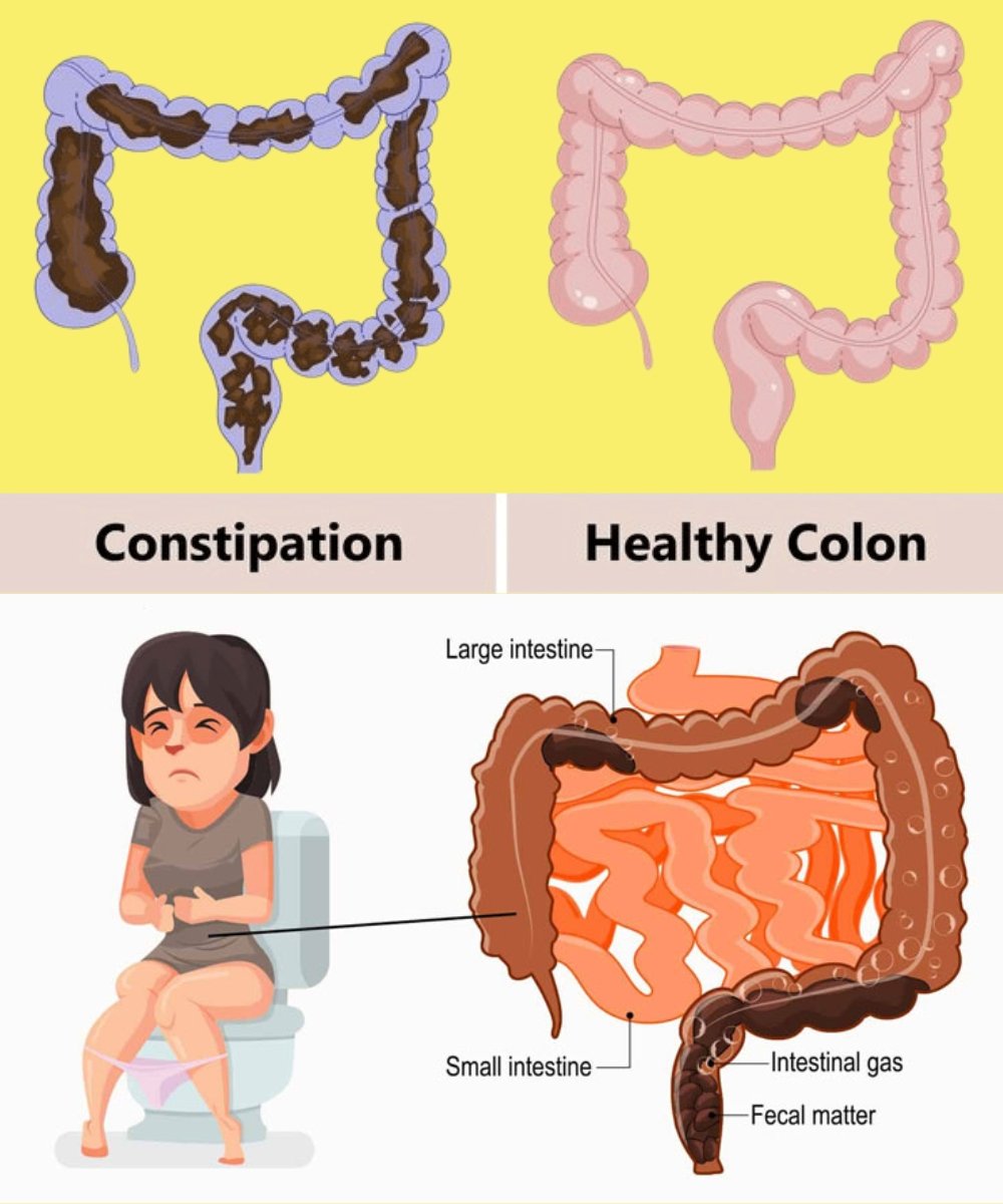 Learn How to Clean 13 Kilograms of Waste from Your Colon in One Night