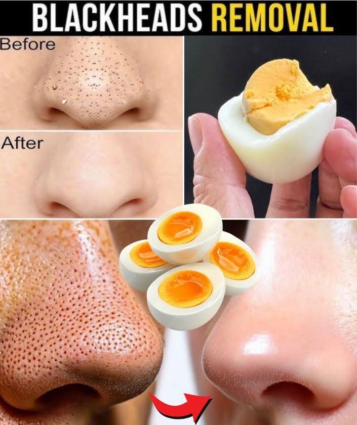  Say Goodbye to Blackheads with Just One Egg – The Complete Guide