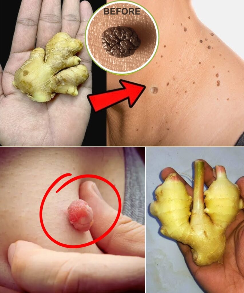 🍋 How I Naturally Removed Skin Tags at Home with Lemon & Ginger