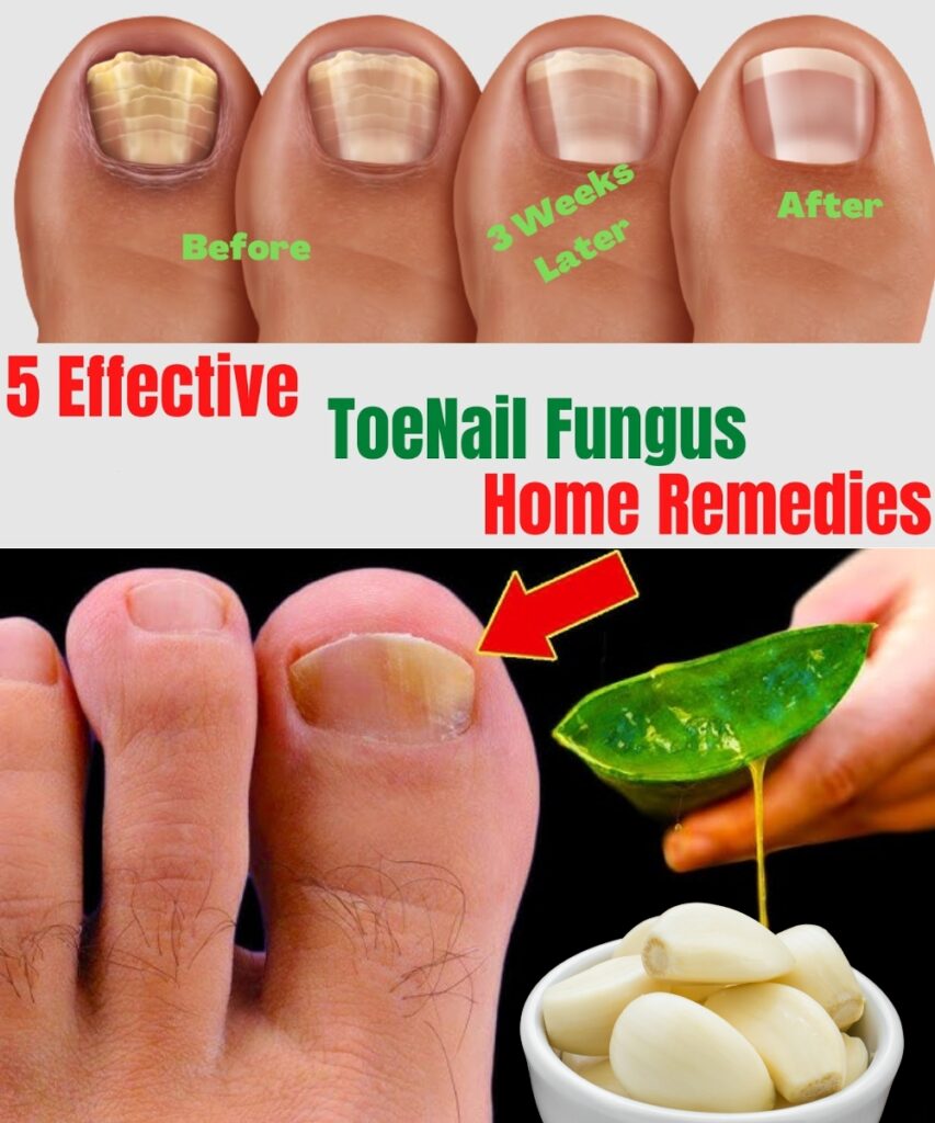 "5 Natural Remedies for Toenail Fungus That Actually Work (Home Treatments That Are Backed by Nature)"