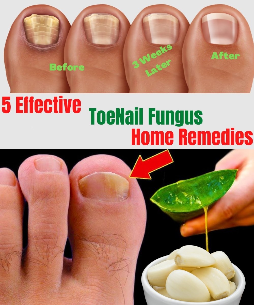 "5 Natural Remedies for Toenail Fungus That Actually Work (Home Treatments That Are Backed by Nature)"
