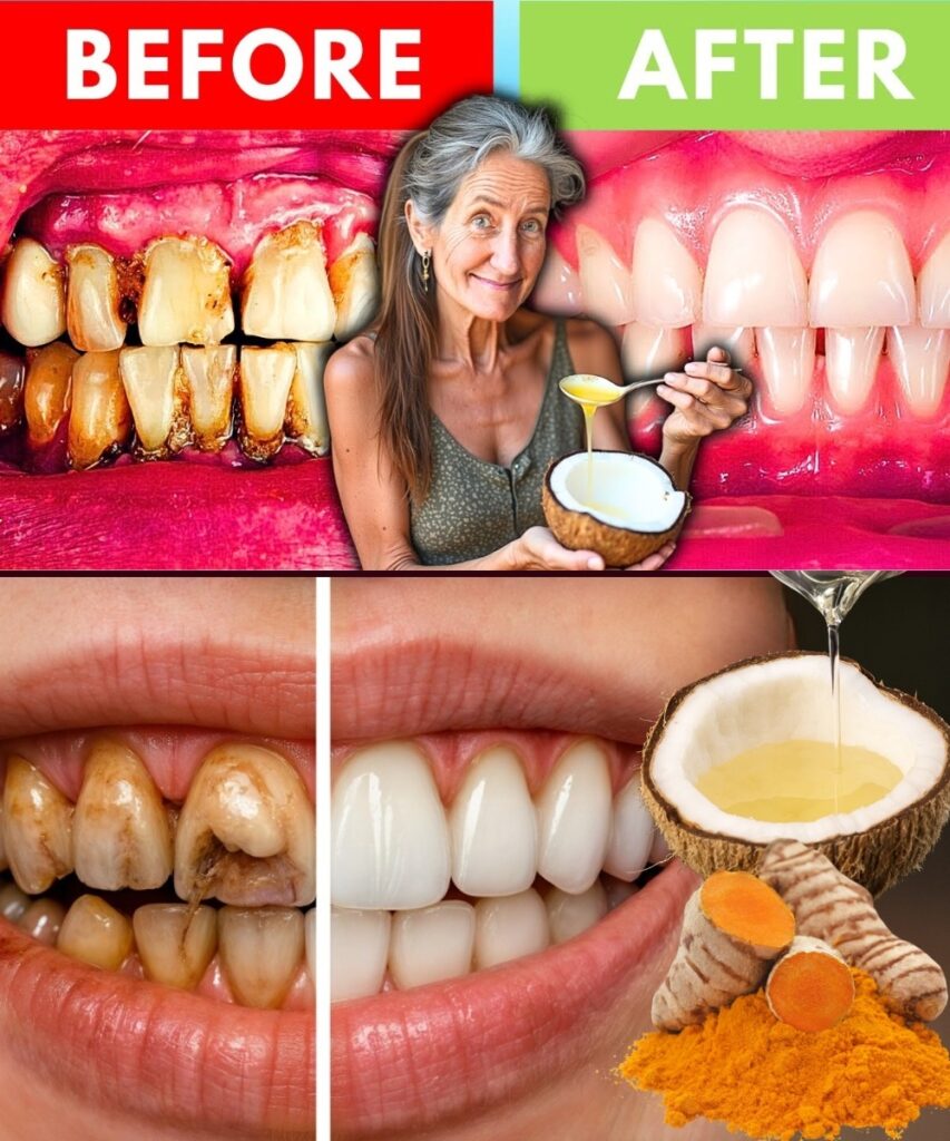 5 Coconut Oil Remedies for Whiter Teeth, Fresher Breath, and Healthier Gums