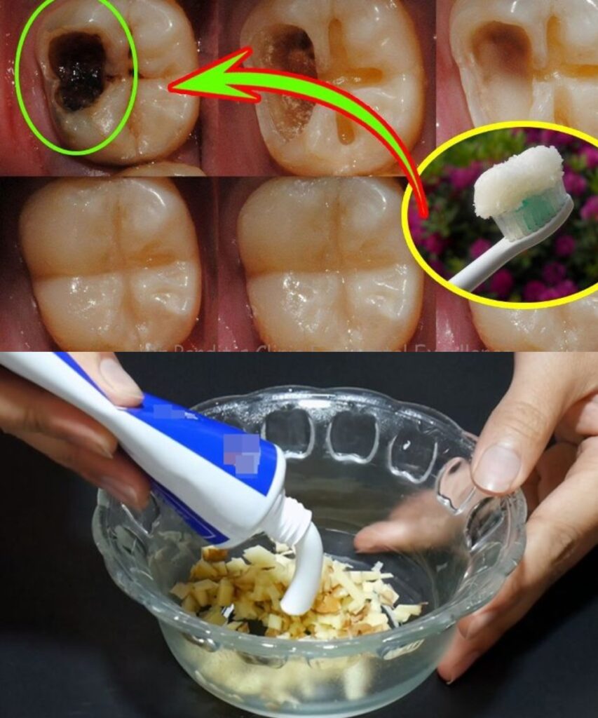 Can You Reverse a Cavity Naturally? Unlock the Secrets to Stronger Teeth! 😁
