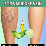 🌿 Grandma’s Remedy for Varicose Veins: A Natural Recipe with Aloe Vera, Apple Cider Vinegar, and Lemon