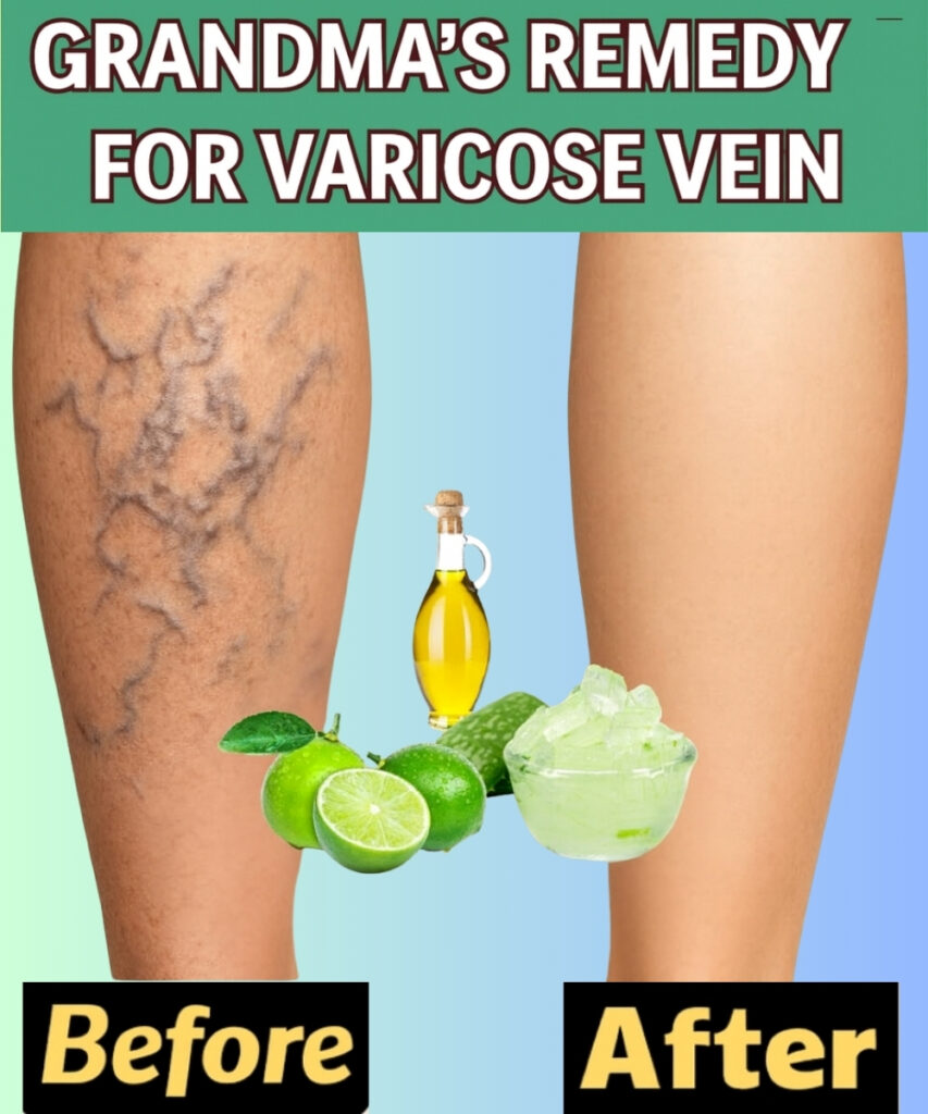 🌿 Grandma’s Remedy for Varicose Veins: A Natural Recipe with Aloe Vera, Apple Cider Vinegar, and Lemon