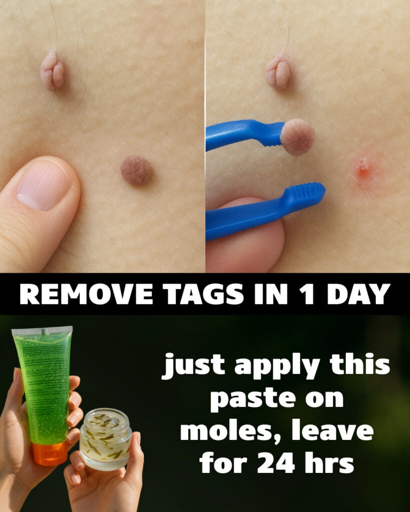 7 Natural Home Remedies To Remove Skin Tags