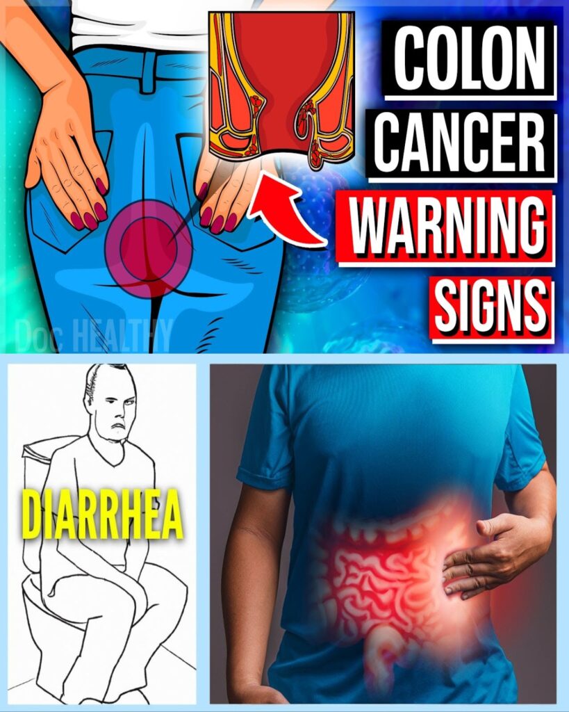8 Early Warning Signs of Colon Cancer You Must Not Ignore