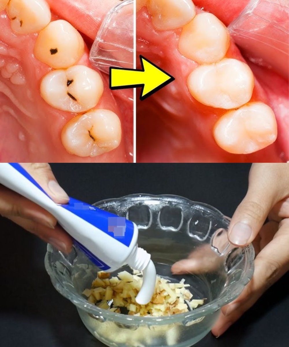 Natural Ways to Strengthen Your Teeth and Protect Against Cavities