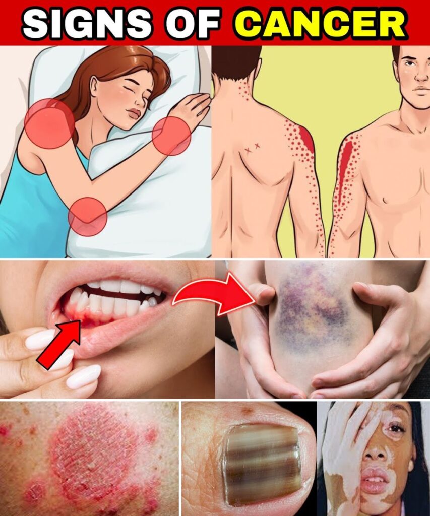  12 Early Cancer Warning Signs You Should Never Ignore – Your Body Might Be Sending You a Message
