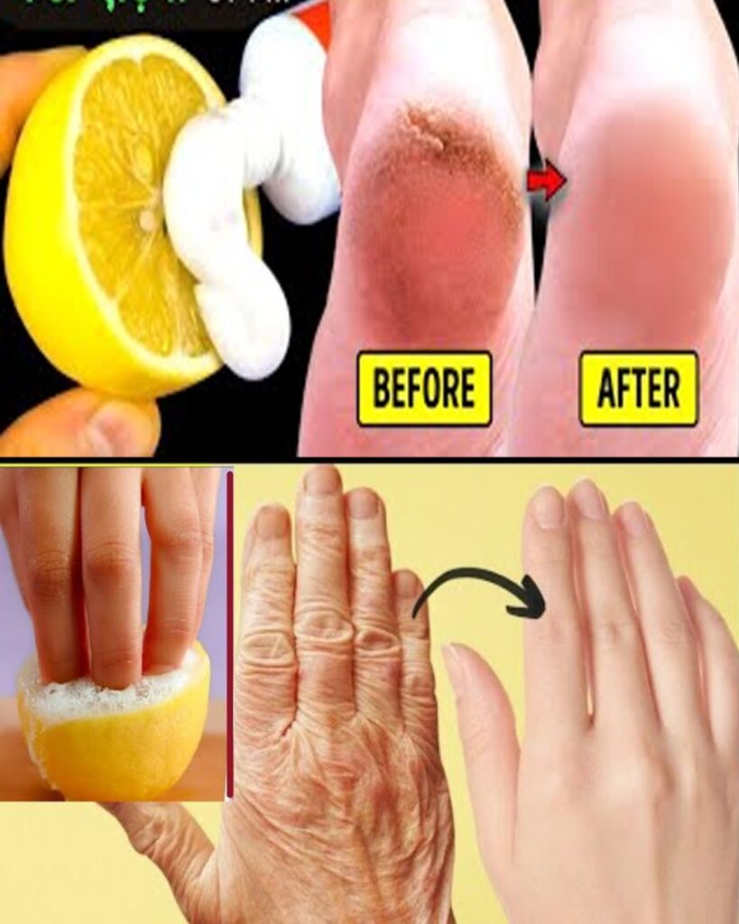 Fade Age Spots Naturally with Lemon Juice