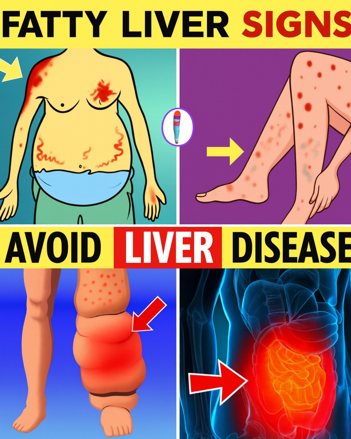 7 Early Signs of Fatty Liver Disease You Shouldn’t Ignore
