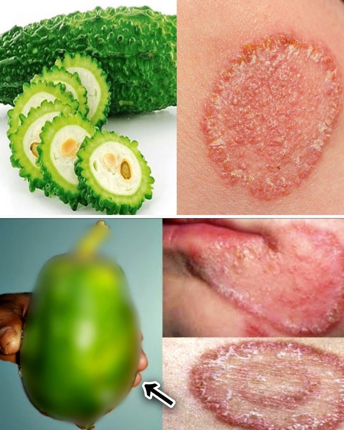 9 Powerful Home Remedies to Get Rid of Fungal Infection (Daad, Khaj, Khujli) Fast