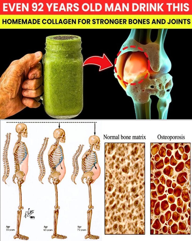 Seniors, Forget Expensive Supplements — Drink This Homemade Collagen Daily to Rebuild Bone Strength