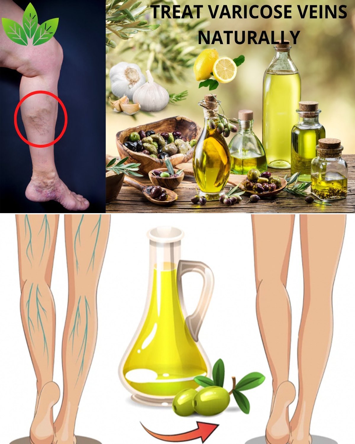 Fade Varicose Veins with Garlic, Onion, and Olive Oil