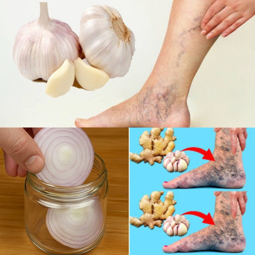 🧄 Soothe Varicose Veins Naturally with This Simple Garlic Trick