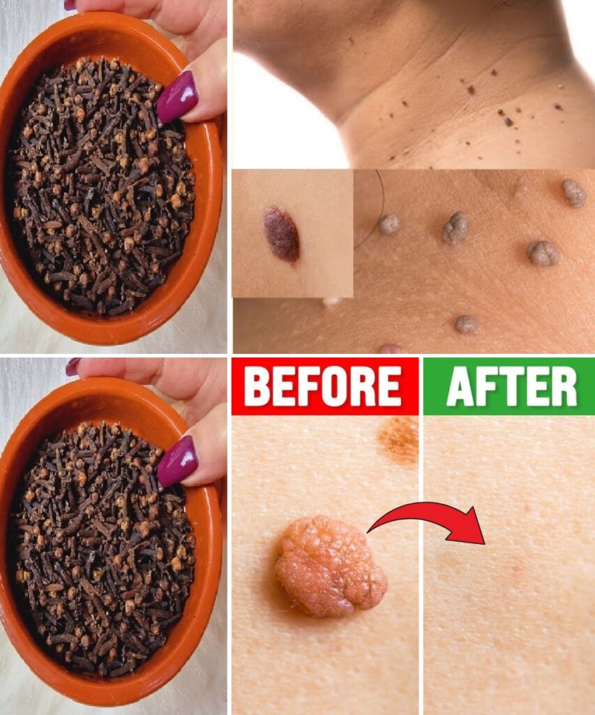 🌿 The Natural Clove Remedy for Skin Tags & Warts: Gentle, Effective, and Time-Tested