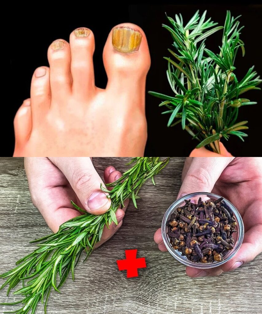 Rosemary and Clove Can Wipe Out Toenail Fungus Fast!