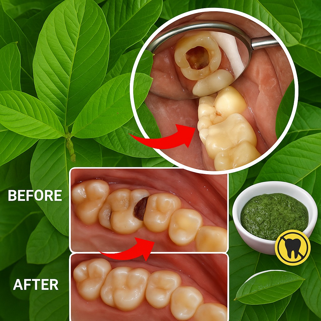 Top 3 Ways Guava Leaves Fight Tooth Decay