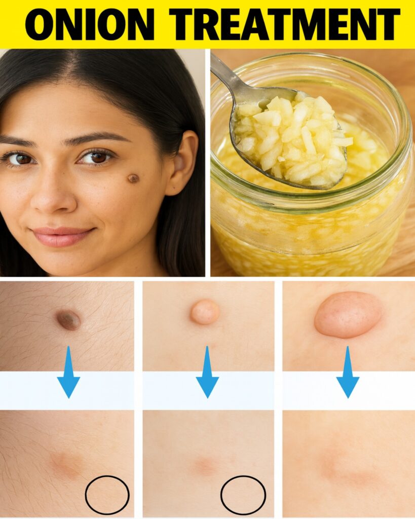 Plantar W.arts and Skin Tags Disappear Overnight with this recipe