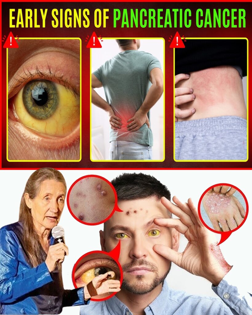 EARLY SIGNS OF PANCREATIC CANCER (Doctors Never Say These Symptoms Of Pancreatic Cancer)