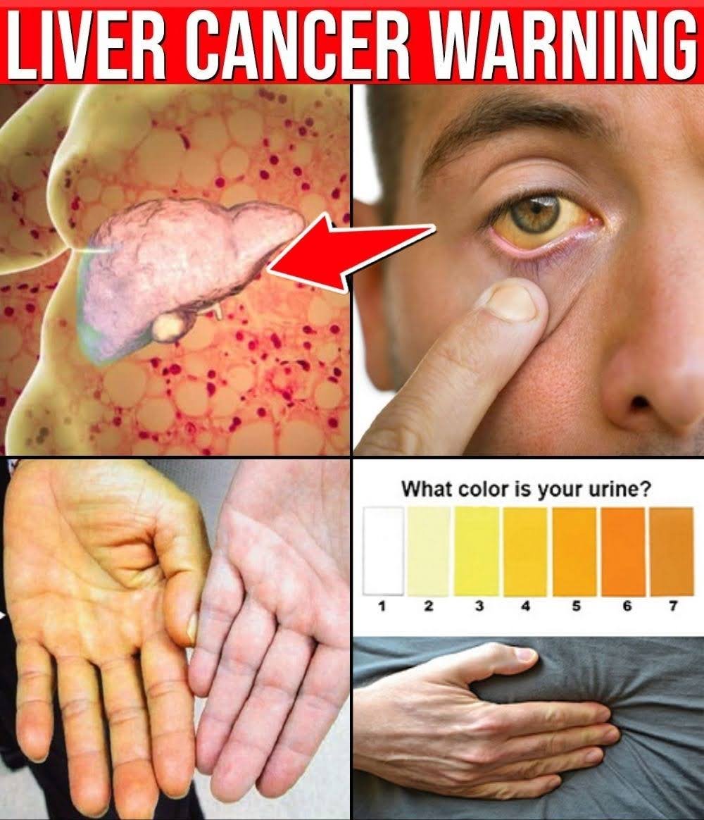 11 Early Liver Cancer Warning Signs You Must Never Ignore! | Healthy Care