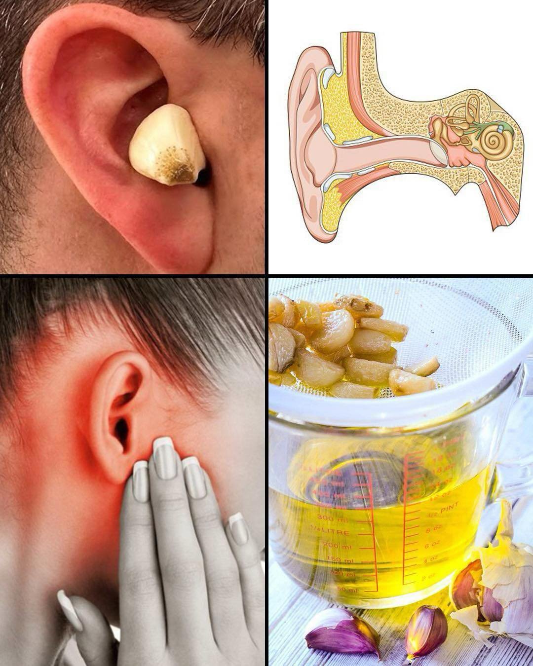 Garlic for Ear Health: Natural Relief and Protection