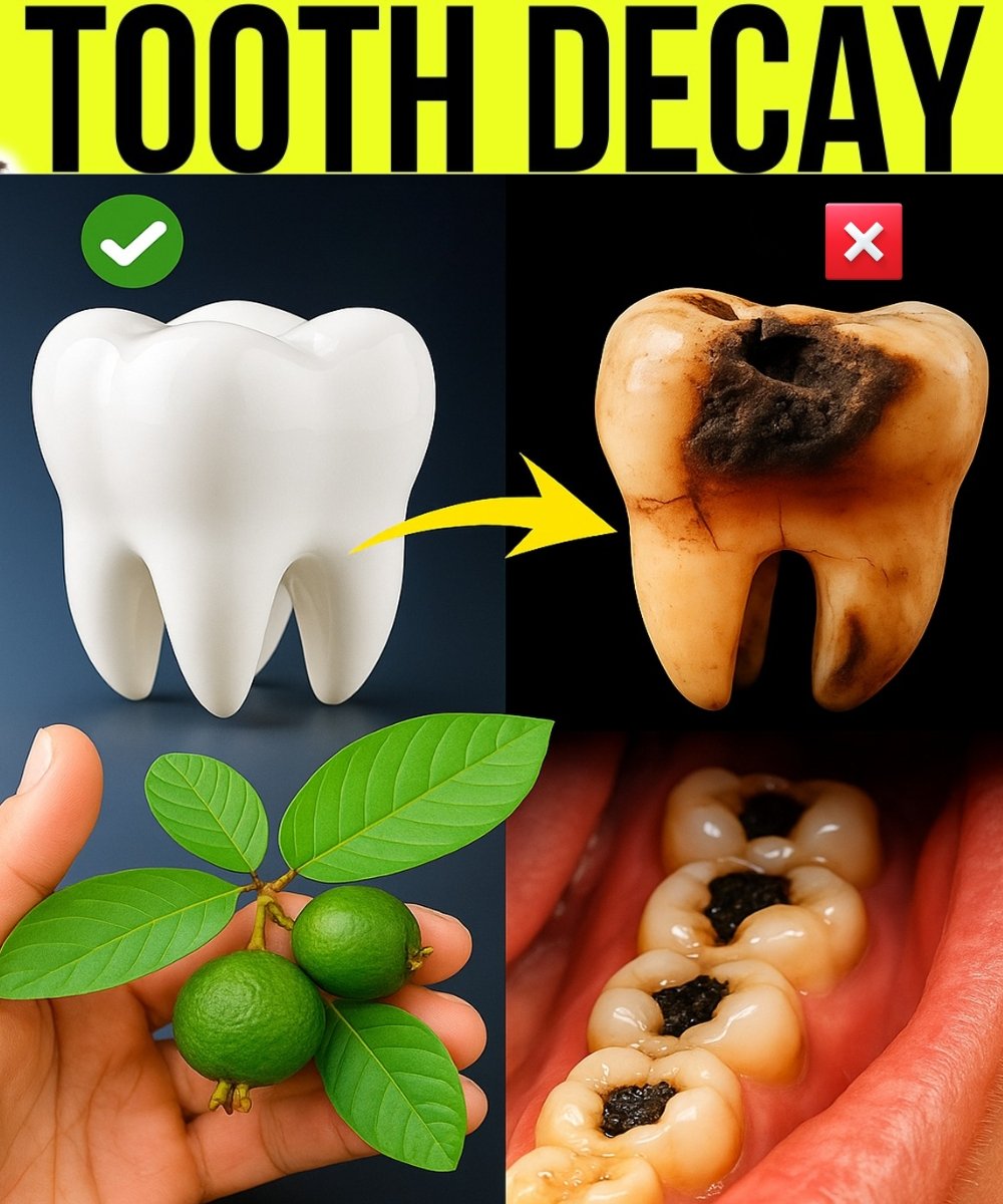 Tooth Decay Repair with Natural Remedies: Can Guava Leaves Help?