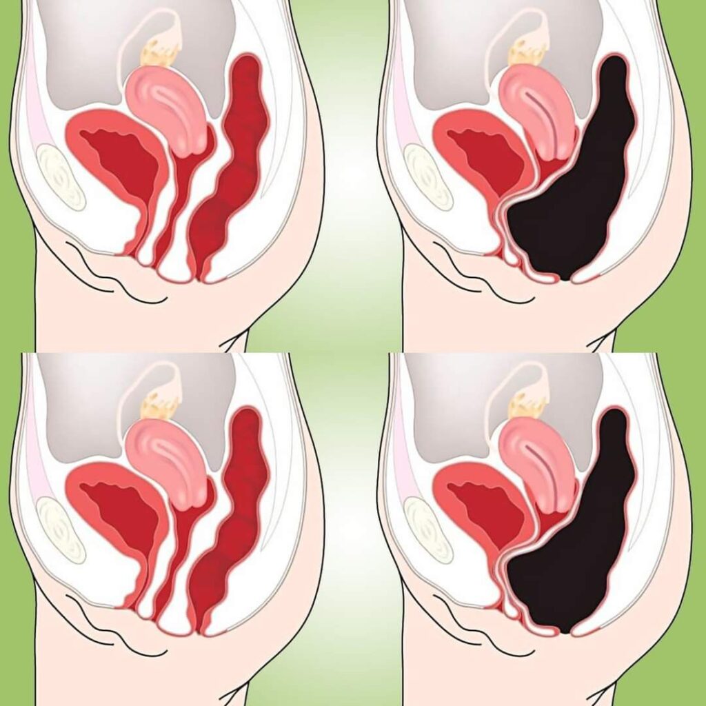 How to Cleanse Your Colon Naturally at Home (Colon Cleanse Smoothie)