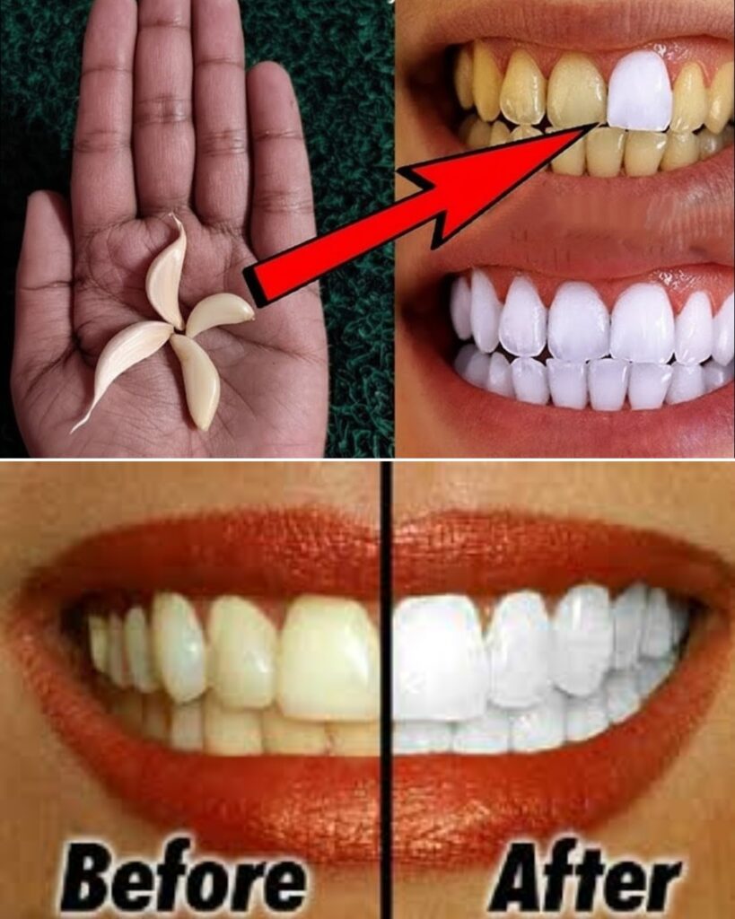 Whiten Your Teeth Naturally with Garlic: The Surprising Secret You’ll Wish You Knew Sooner