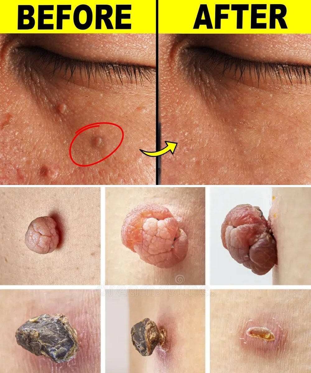8 Natural Ways to Get Rid of Milia (White Bumps) Using Simple Home Ingredients