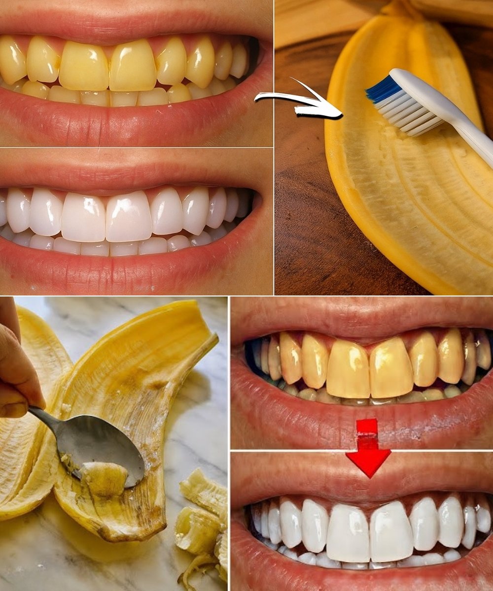 Before You Throw Away Banana Peels: The Secret Dentists Don’t Want You to Know – It Whitens Teeth in Just 2 Minutes! 🪥🦷