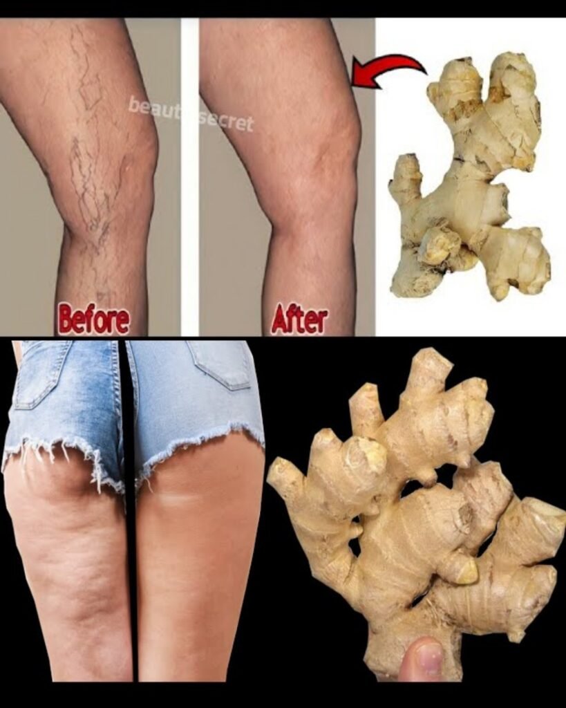 Seniors, Rub THIS 2-Ingredient Ginger Paste on Your Legs Tonight & Watch Varicose Veins Fade + Cellulite Dimples Vanish in 14 Nights