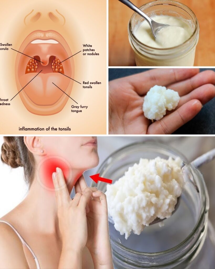 3 Powerful Home Remedies for Tonsil Stones That Work Fast (Tonsilloliths)