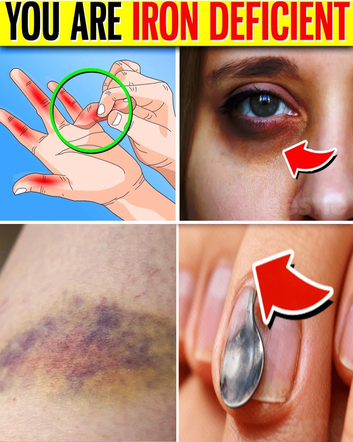 10 Alarming Signs You May Have an Iron Deficiency (Anemia)