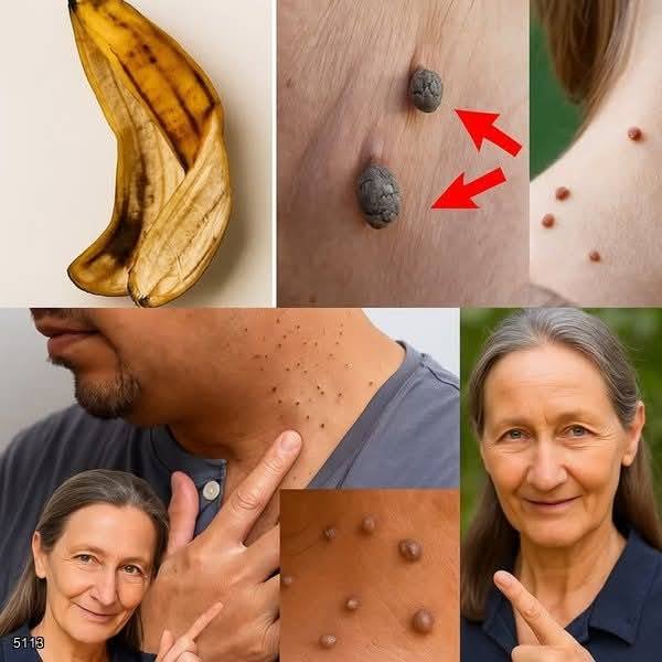 Plantar Warts and Skin Tags Disappear Naturally—Try This Overnight Remedy