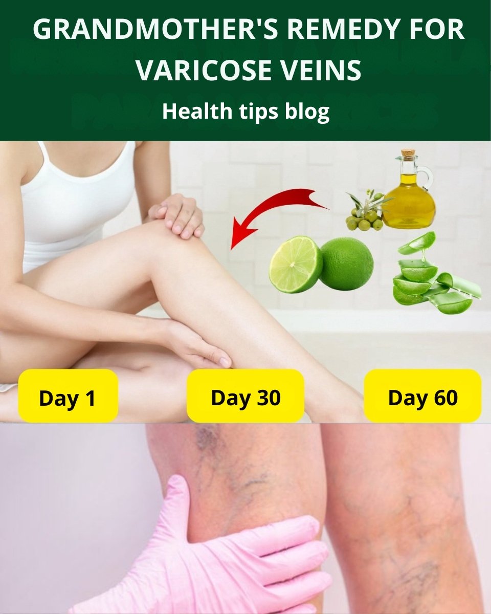 🌿 Grandma’s Gentle Varicose-Vein Remedy: Aloe Vera, Apple Cider Vinegar & Lemon