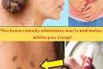 🌿 Remove Skin Tags and Warts Naturally — A Gentle Remedy That Works ✨