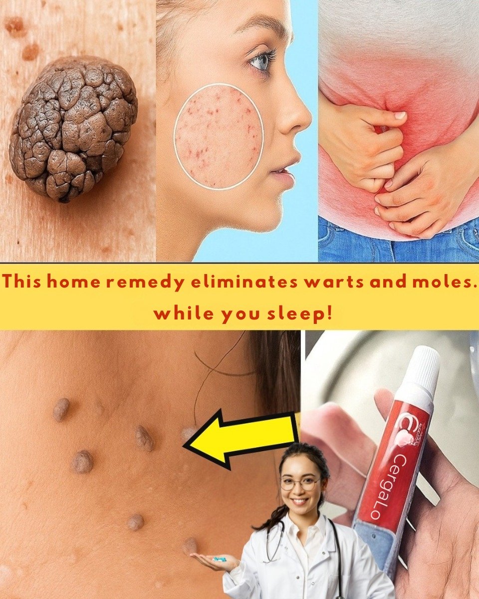 🌿 Remove Skin Tags and Warts Naturally — A Gentle Remedy That Works ✨