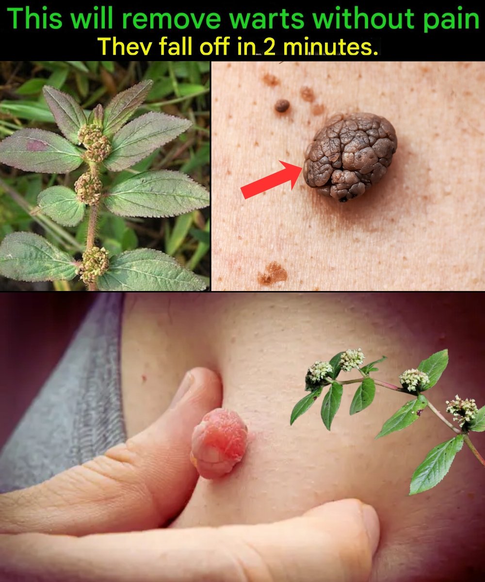 🌿 This Leaf Makes Warts Fall Off Quickly — Try It Today!