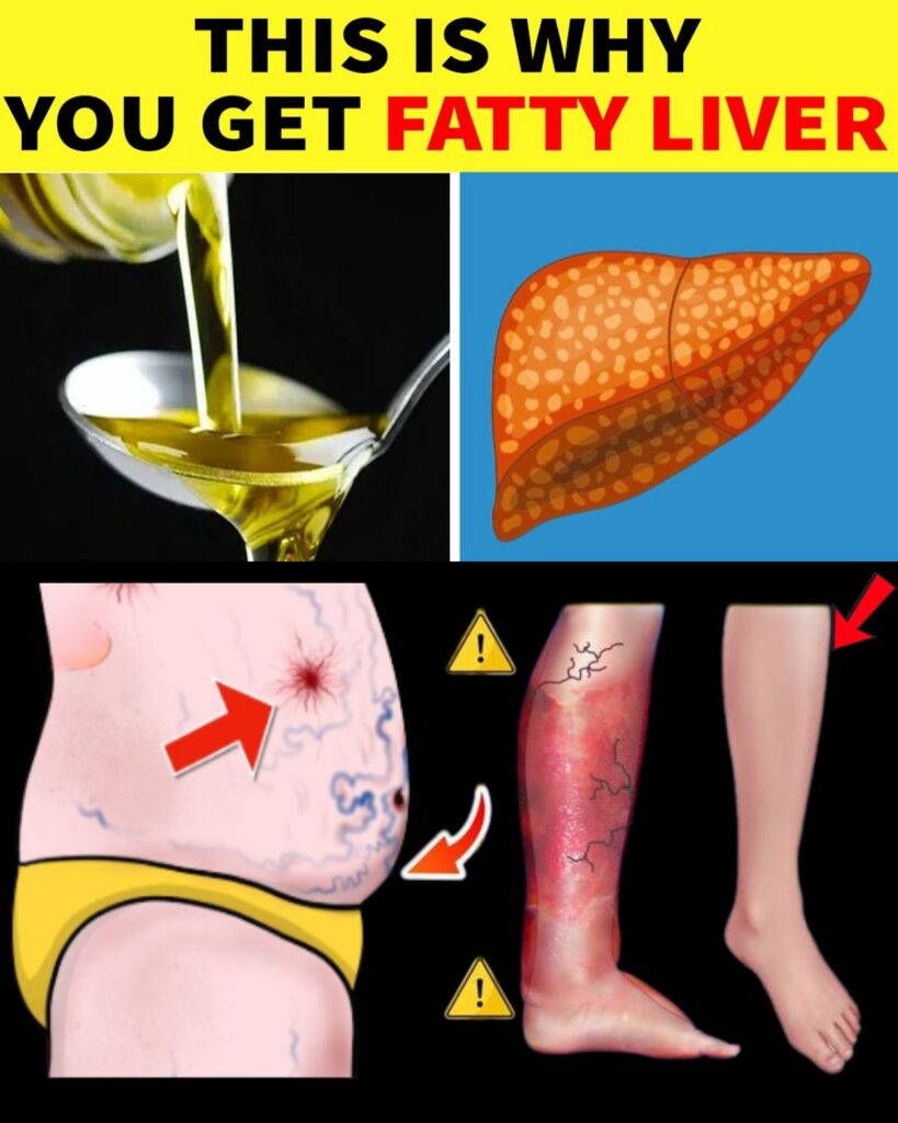 This Common Mistake Causes Fatty Liver—Don’t Do It!