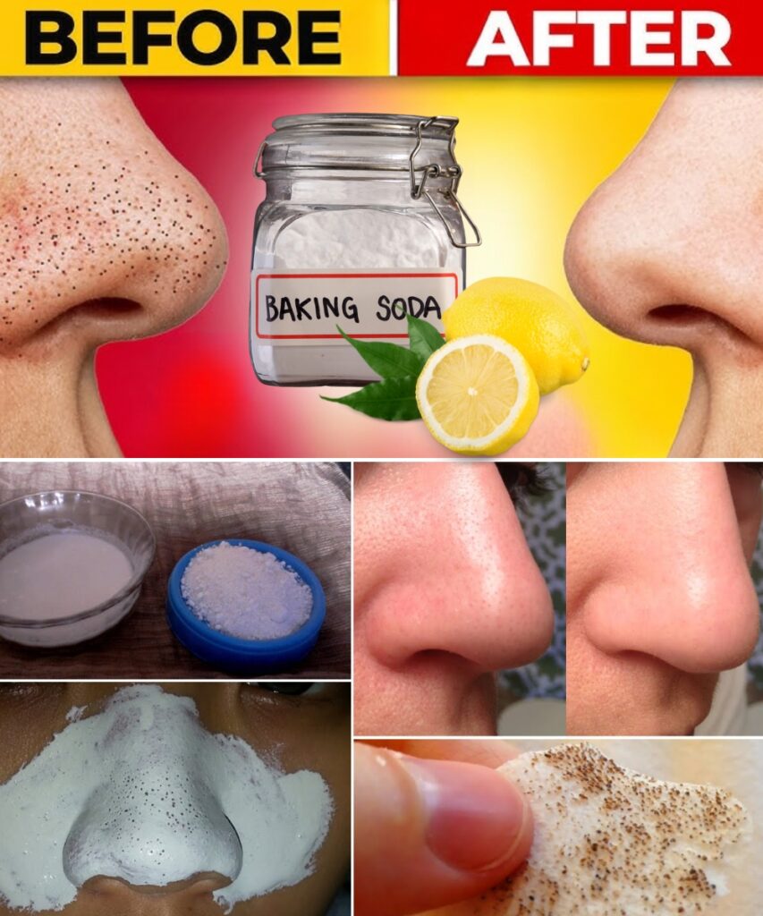 12 Natural Ways to Instantly Get Rid of Blackheads at Home