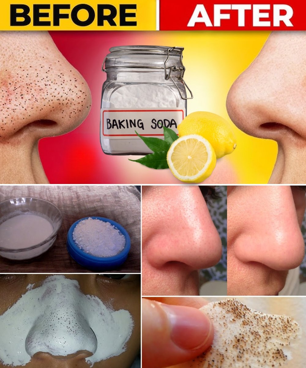 12 Natural Ways to Instantly Get Rid of Blackheads at Home