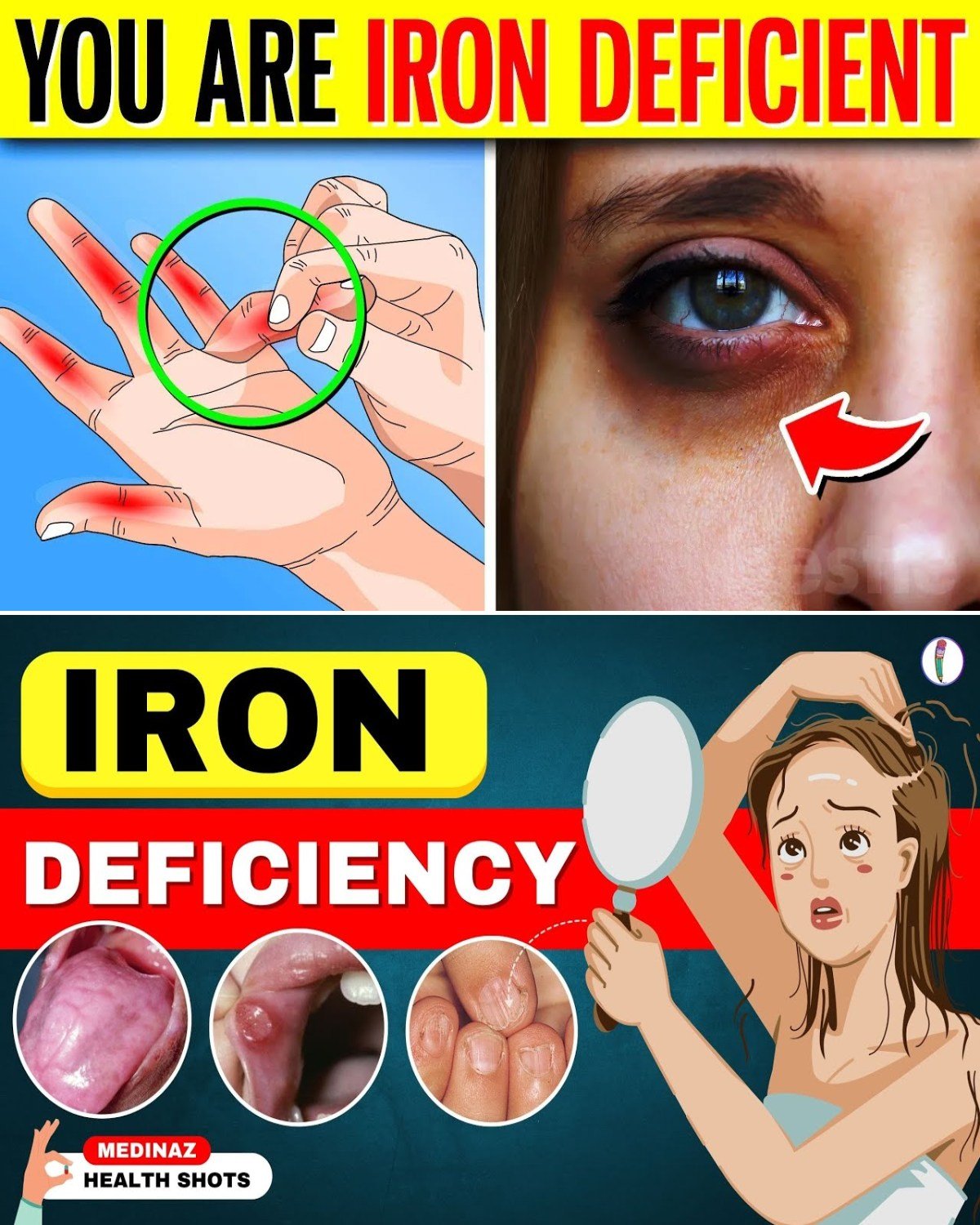 10 ALARMING Signs You Have An Iron Deficiency (And You’re Probably Ignoring #7, #8 and #9 Right Now)