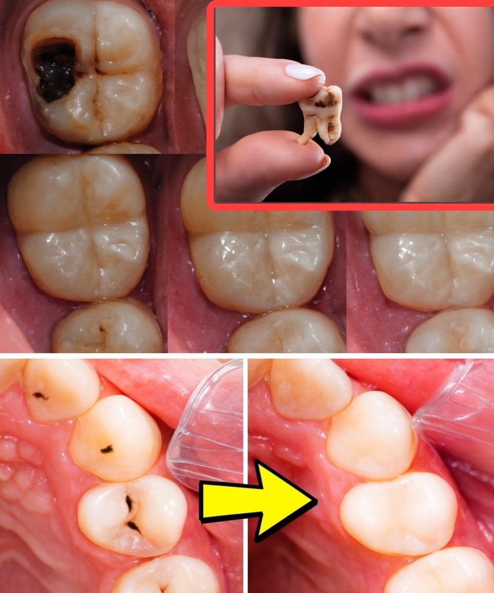 How to Naturally Repair a Cavity: Tips to Keep Your Teeth Strong & Avoid the Dentist