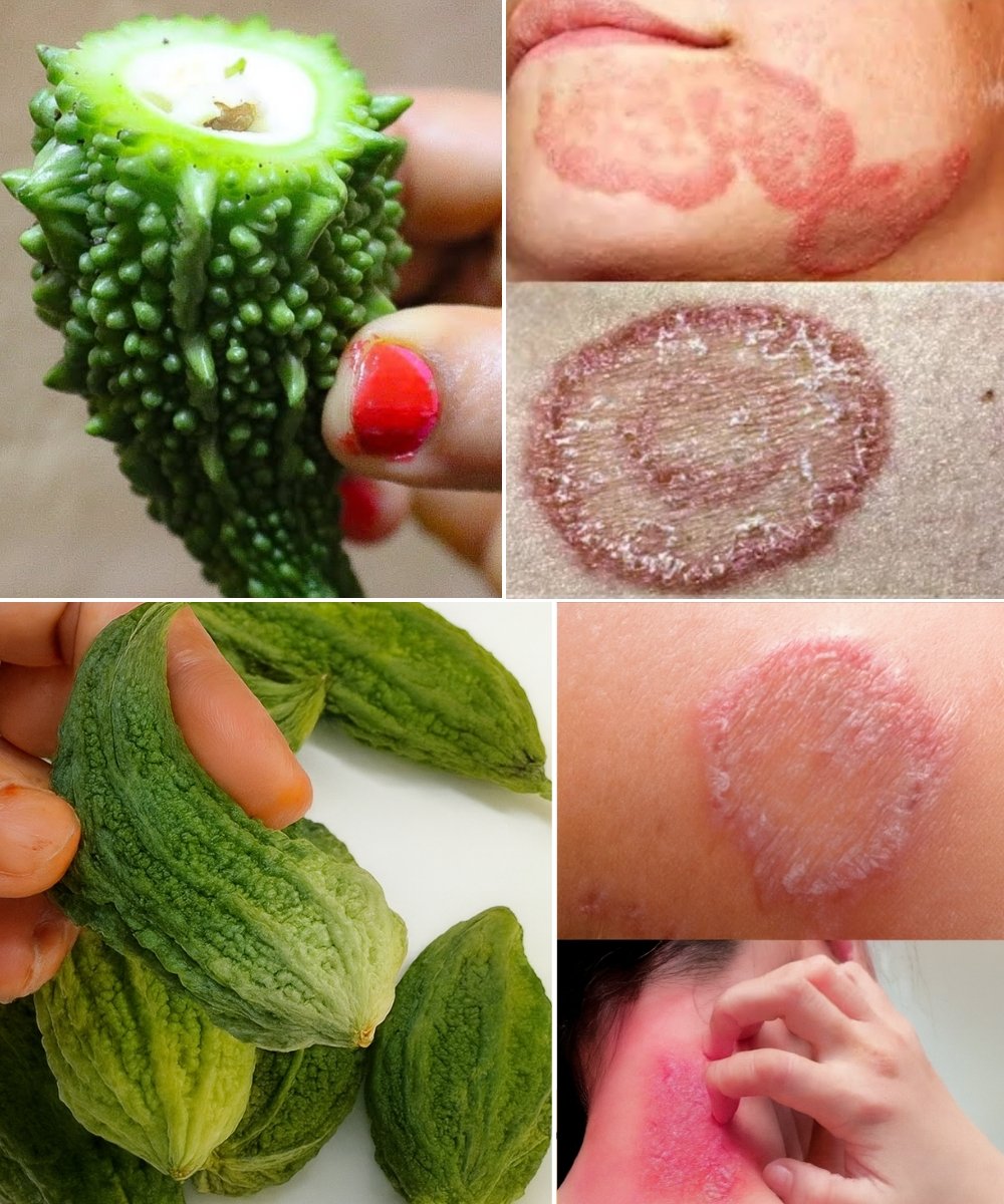 2-Day Natural Cure for Ringworm & Fungal Infections With Bitter Gourd: Benefits, Uses & Results
