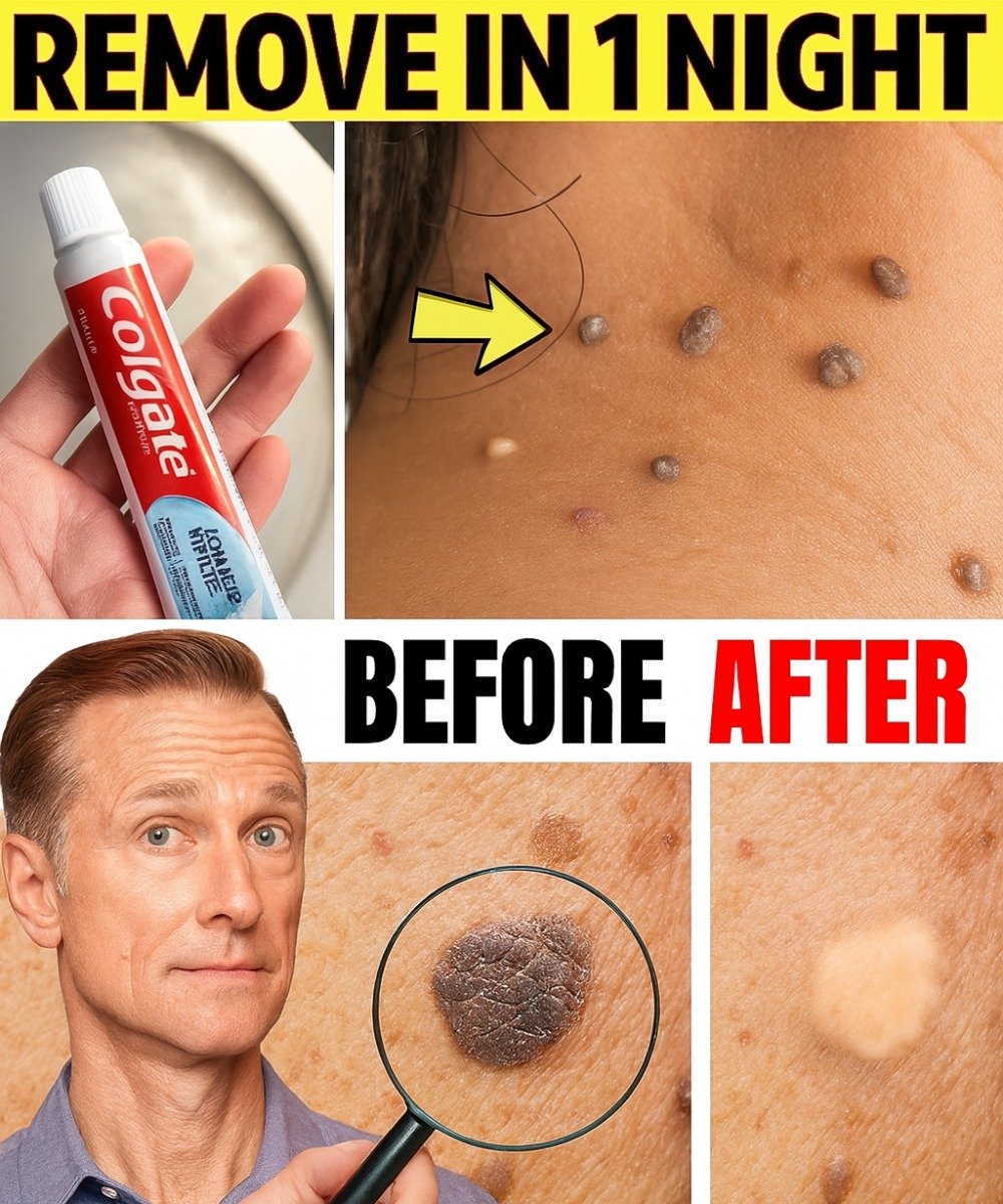 How to Remove Warts and Skin Tags Naturally at Home (Safe & Gentle)