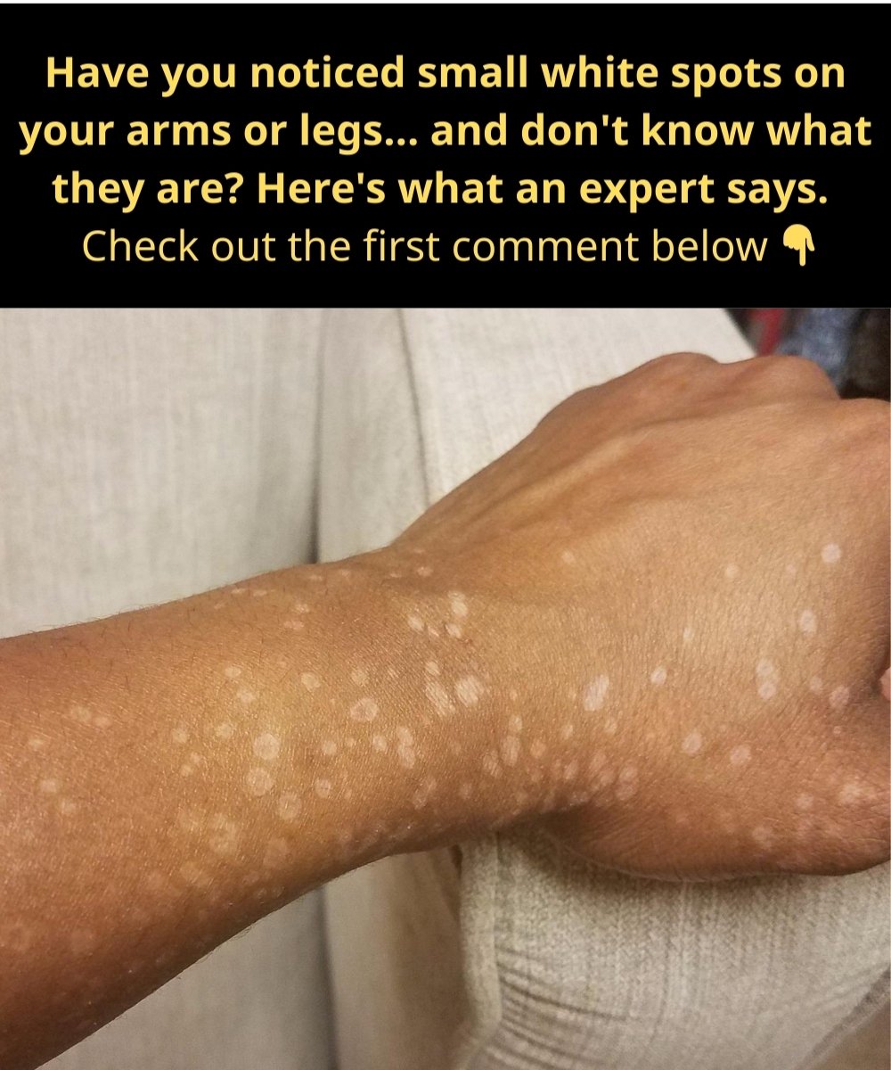Why Do White Spots Appear on Your Skin? Hidden Causes You Shouldn’t Ignore