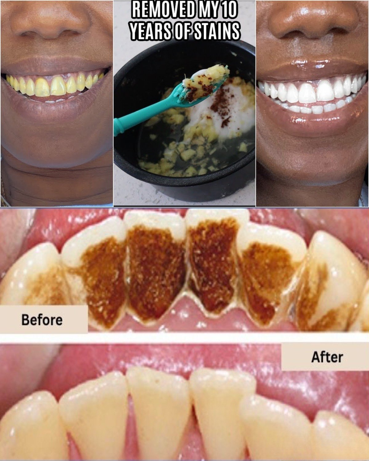 Whiten Teeth in 2 Minutes: The Banana Peel Secret That Shocks Everyone