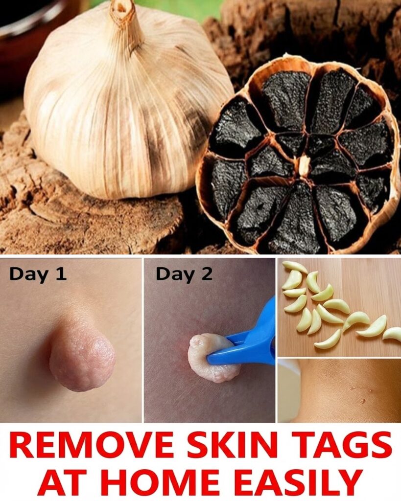 15 Surprising Reasons Vaseline Might Help Fade Skin Tags Overnight (And Why You’ll Wish You Knew This Sooner)